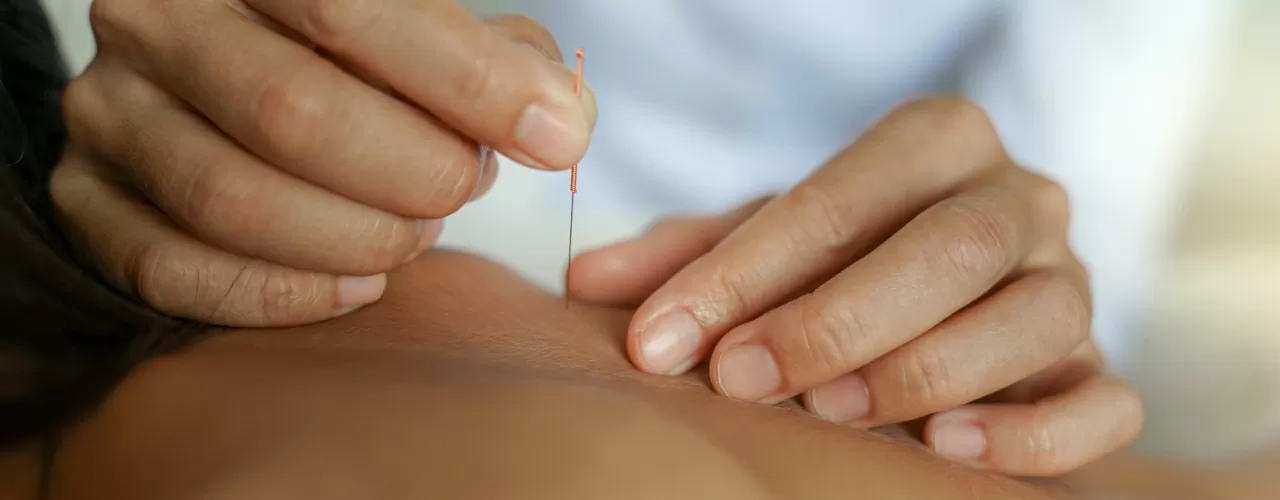 Dry Needling